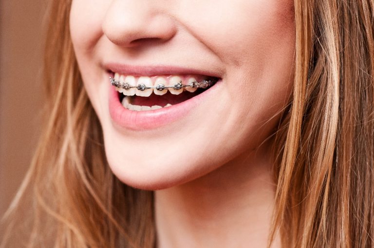 woman with braces
