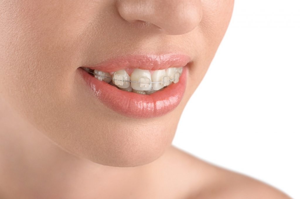 woman with clear braces